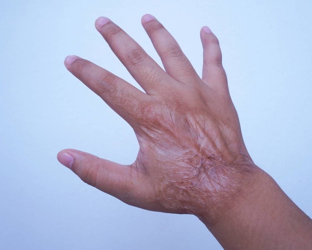 درمان-زخم-سوختگی-هیل-ازون